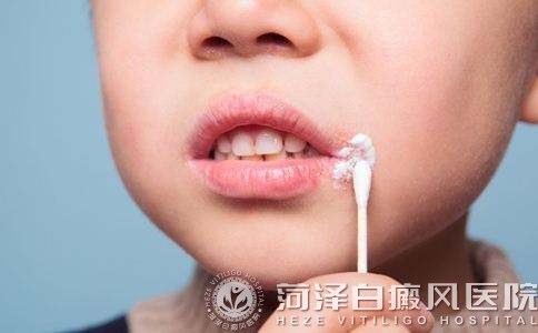 山东菏泽白癜风高等专科医院
