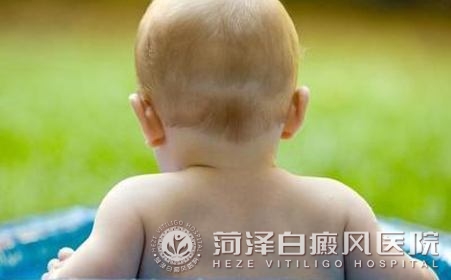 山东菏泽白癜风高等专科医院
